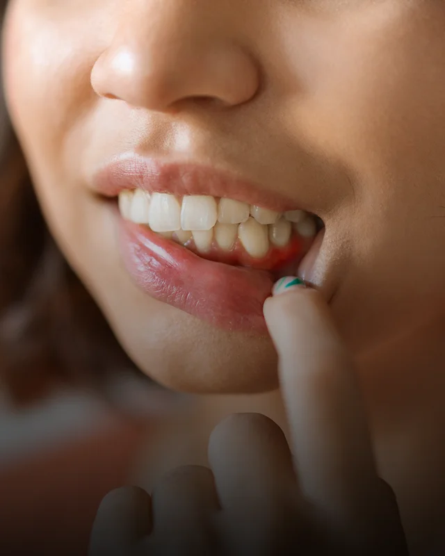 A patient pulling back their lip to show red, inflamed gums