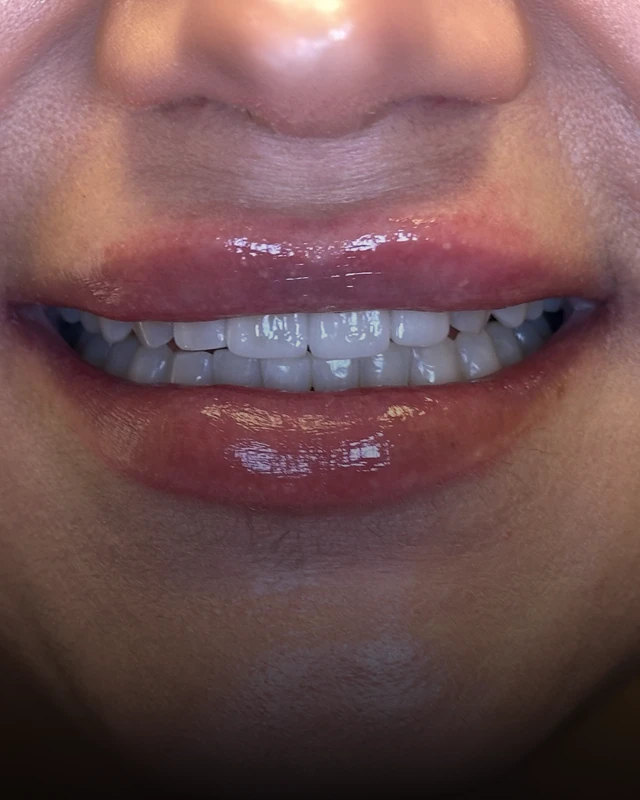 A close up photo of a patient's restored smile
