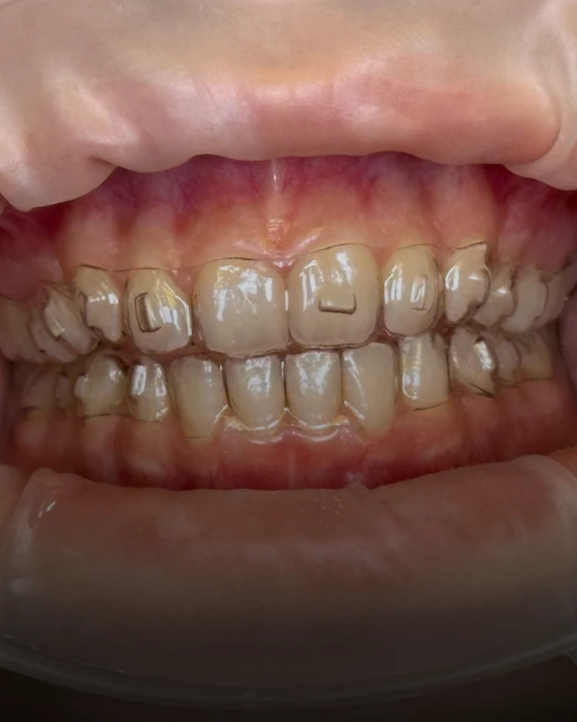 A closeup photo of a patient's mouth with clear aligners applied